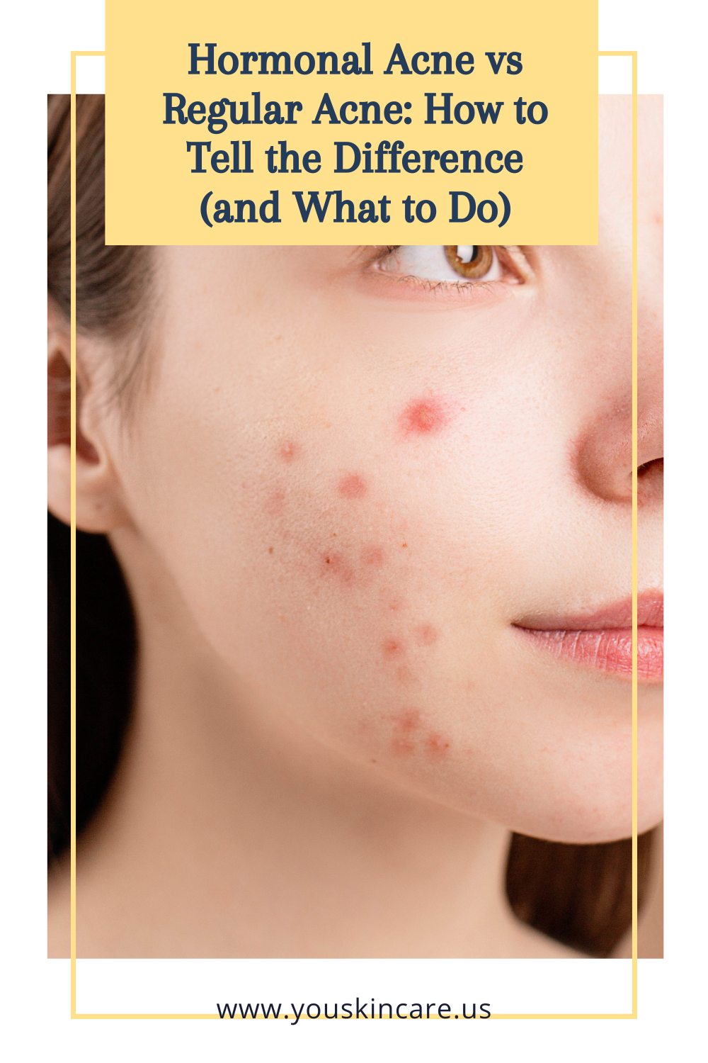 Hormonal Acne vs Regular Acne: How to Tell the Difference (and What to Do)