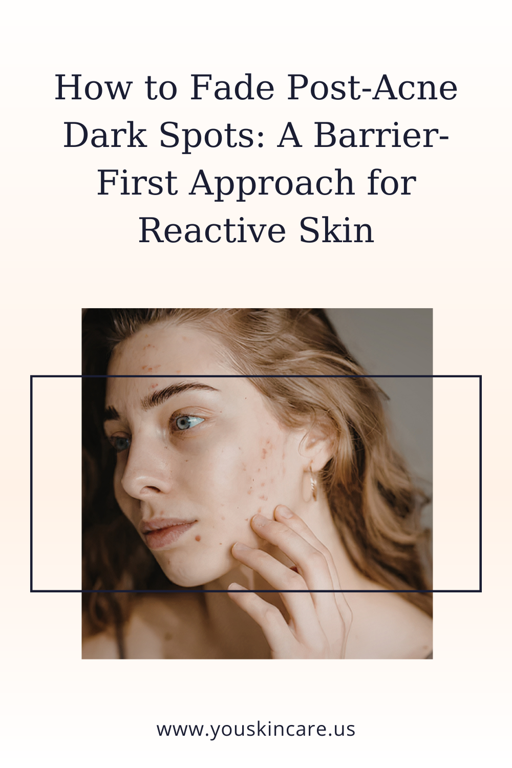 How to Fade Post-Acne Dark Spots: A Barrier-First Approach for Reactive Skin