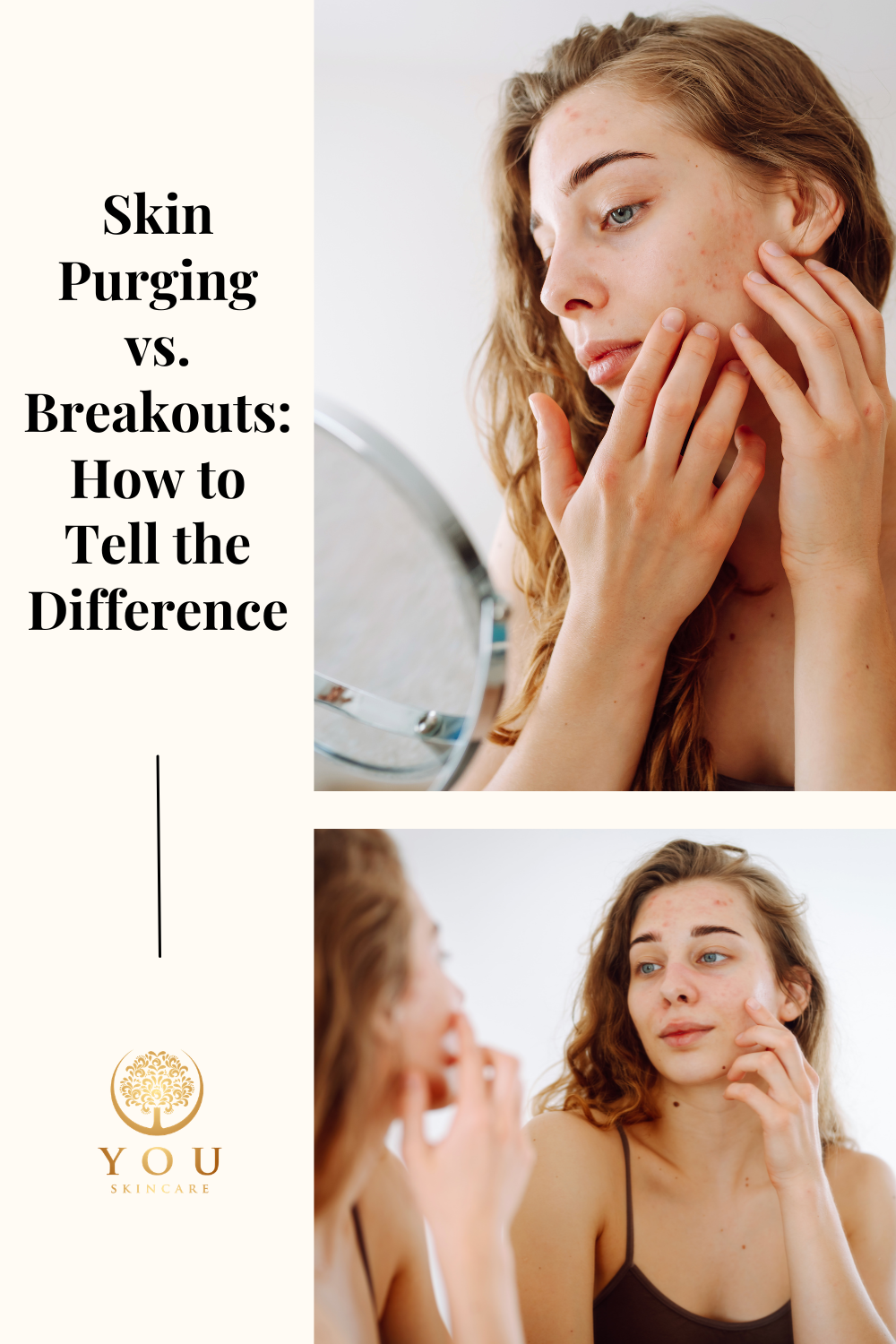 Skin Purging vs. Breakouts: How to Tell the Difference