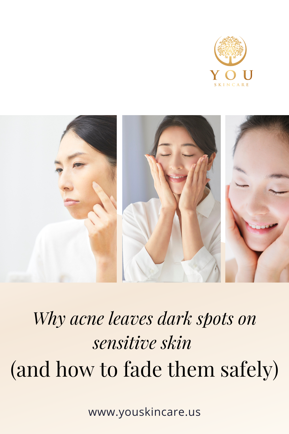 Why acne leaves dark spots on sensitive skin 