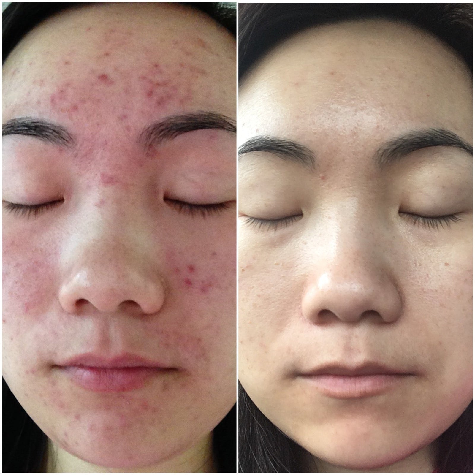 How I Cleared My Acne by Repairing My Skin Barrier (After Making It Worse)